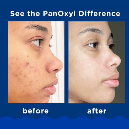 PanOxyl ®️ Acne Creamy Wash 4% Benzoyl Peroxide Daily Control • Acne Creamy Wash Against Acne & Further Outbreak Of Acne • 1x170gr
